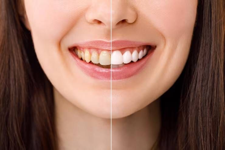 Teeth Whitening's Teeth Whitening's